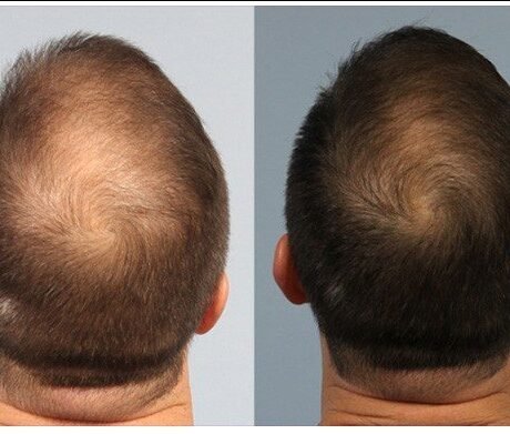 prp before and after hair treatments image prp