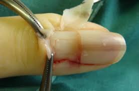 biopsy of nail